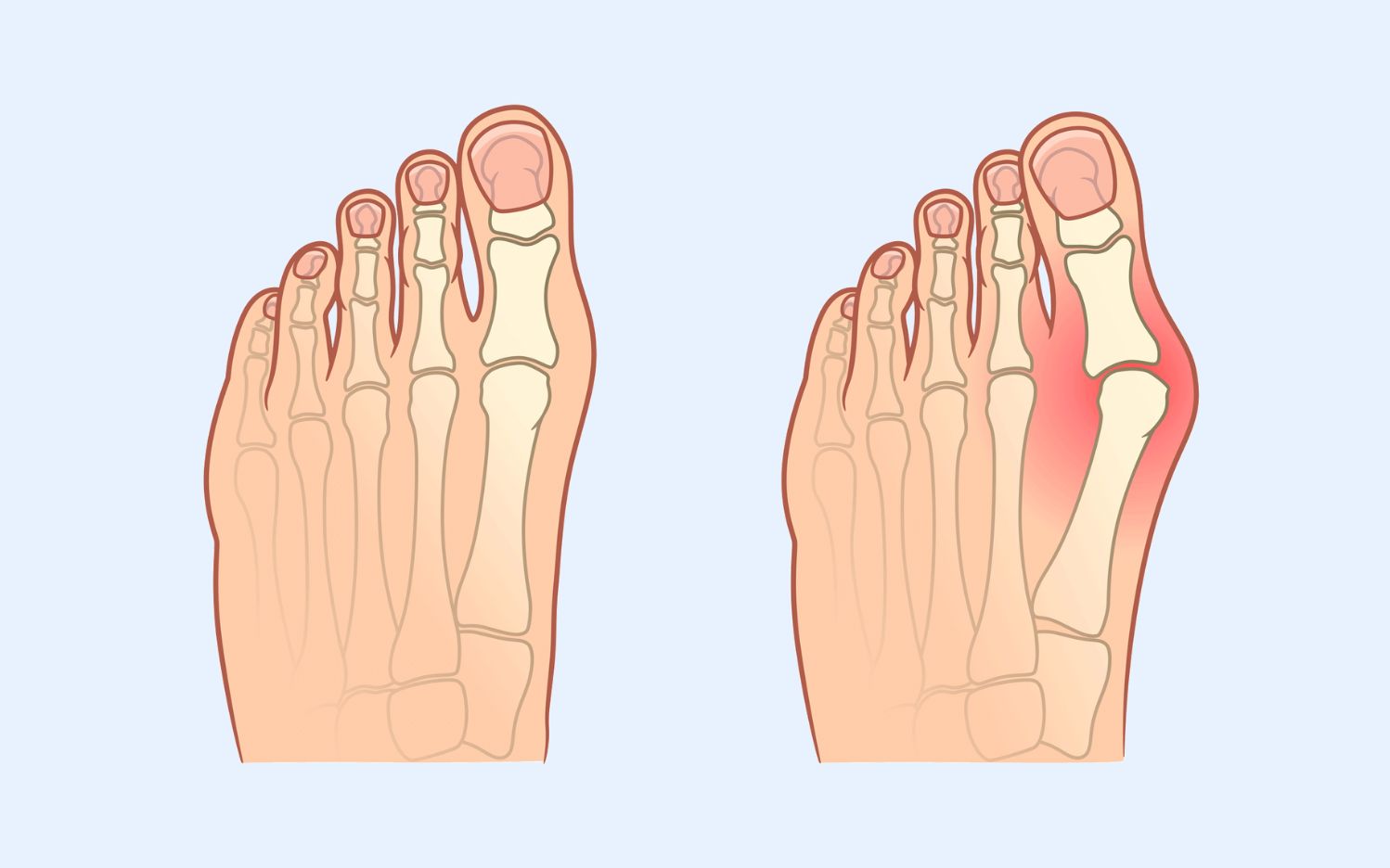 Diagram showing comparison between normal foot bones and foot with bunion showing swelling at the big toe joint